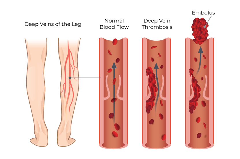 What is DVT